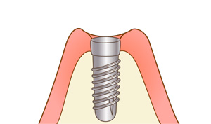 箕面市の歯医者なら痛みを少なく安心して通える尾川歯科医院