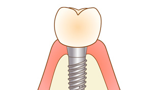 箕面市の歯医者なら痛みを少なく安心して通える尾川歯科医院