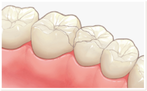セラミックインレー