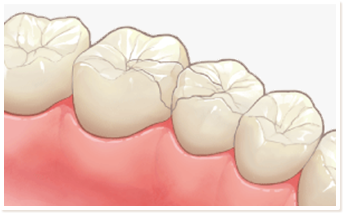 セラミックインレー