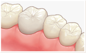 セラミッククラウン