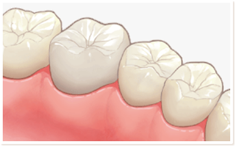 セラミッククラウン