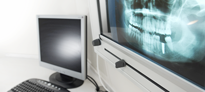 歯のレントゲン画像
