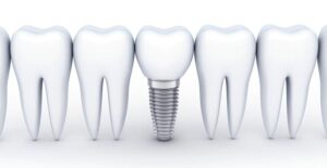 インプラントの模型