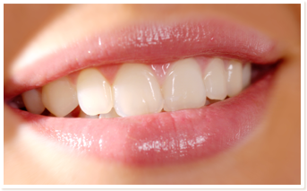 デュアルホワイトニングした女性の歯