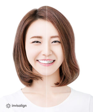 金属アレルギーの心配がない