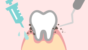 虫歯治療のイラスト