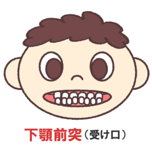 受け口
