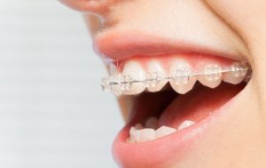 ワイヤ矯正をしている女性