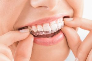 ホワイトニングのマウスピースを着ける女性