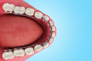 ハーフリンガル矯正の模型