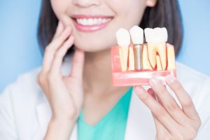 インプラントの模型を持つ女性