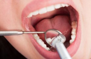 根管治療の治療を受ける女性