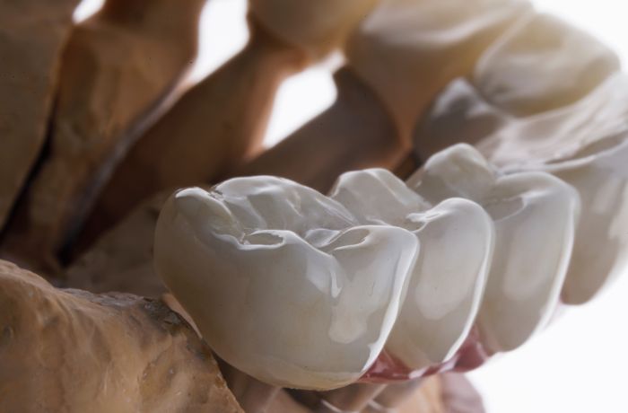 セラミックの歯