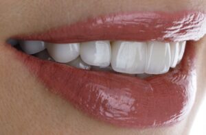 セラミックの被せものをした女性の歯